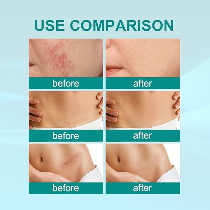 Proregen Medical Scar Removal Spray